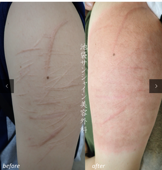 白い傷跡の治療14