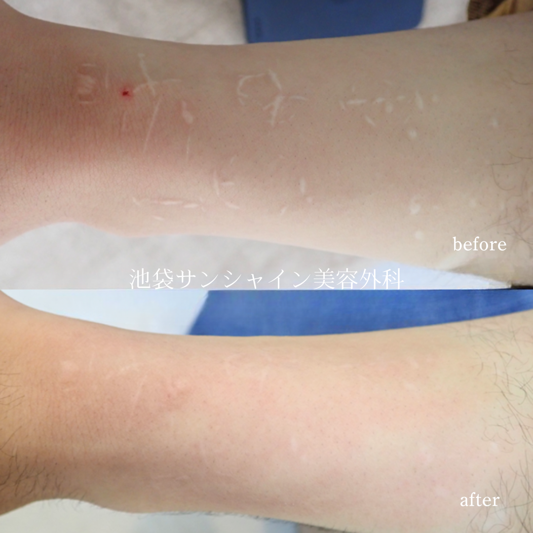 ご自身で針で傷をつけられた症例