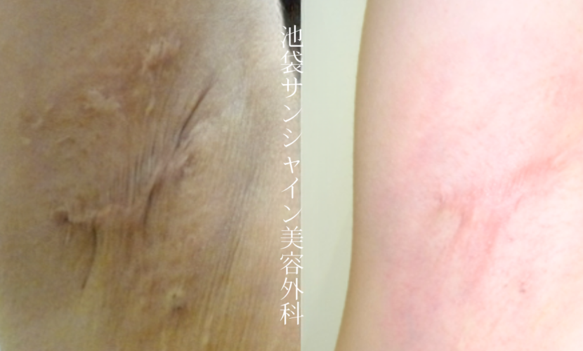 わきが手術後の拘縮のある傷の症例