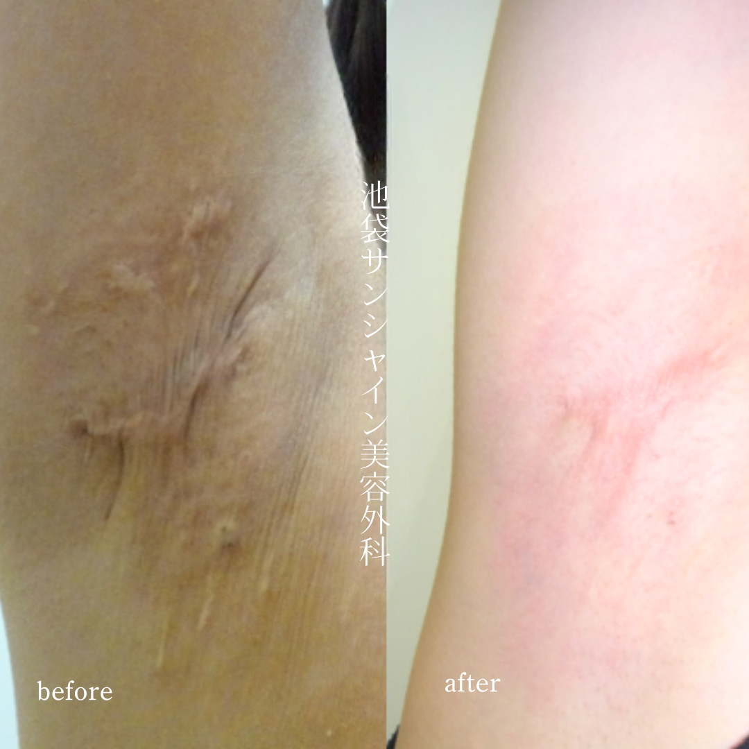 わきが手術後の拘縮のある傷の症例