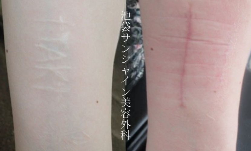 リストカット修正手術