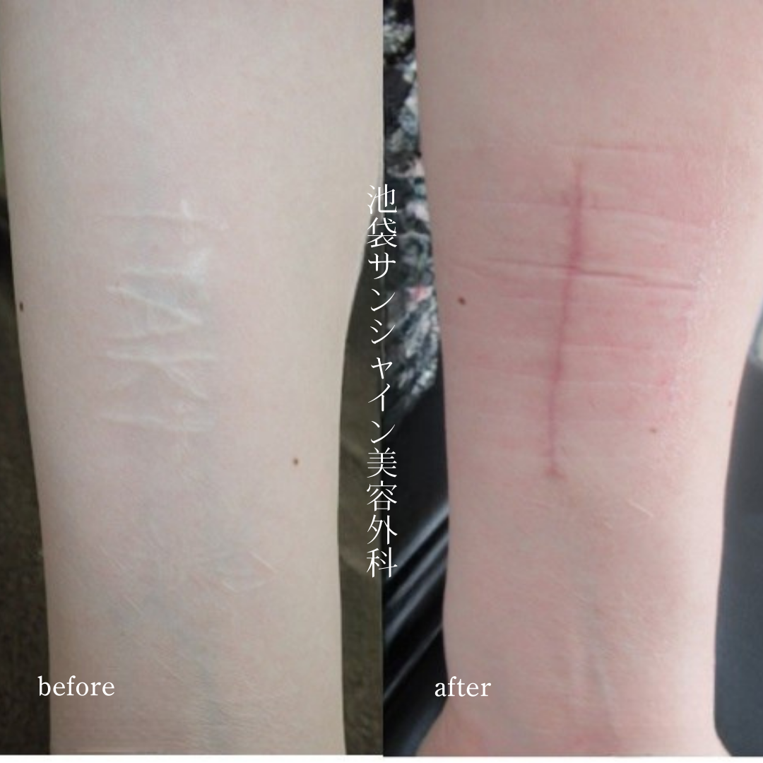 リストカット修正手術