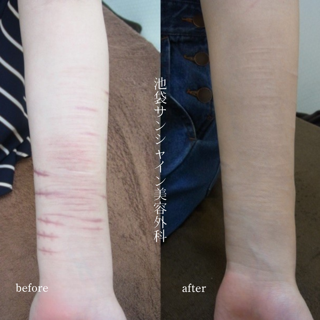 リストカット治療左前腕