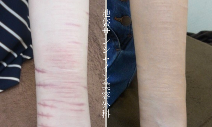 リストカット治療左前腕