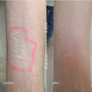 【現役医師監修】リスカ跡の白い線を消すことはできる?原因・治療法・費用まで徹底解説 7 左前腕 古い白い傷の症例