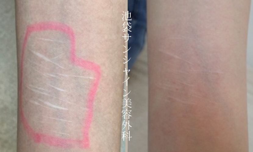 左前腕　古い白い傷の症例