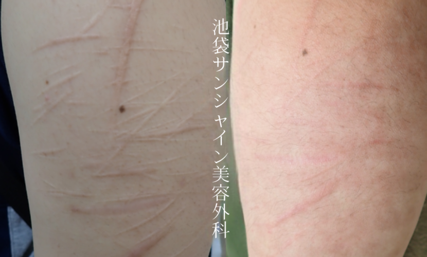 左上腕盛り上がった傷が多数ある症例