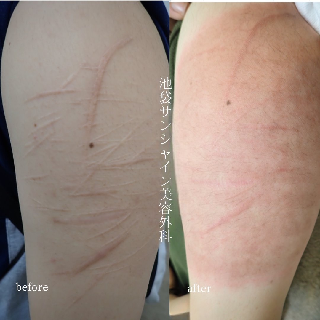 左上腕盛り上がった傷が多数ある症例