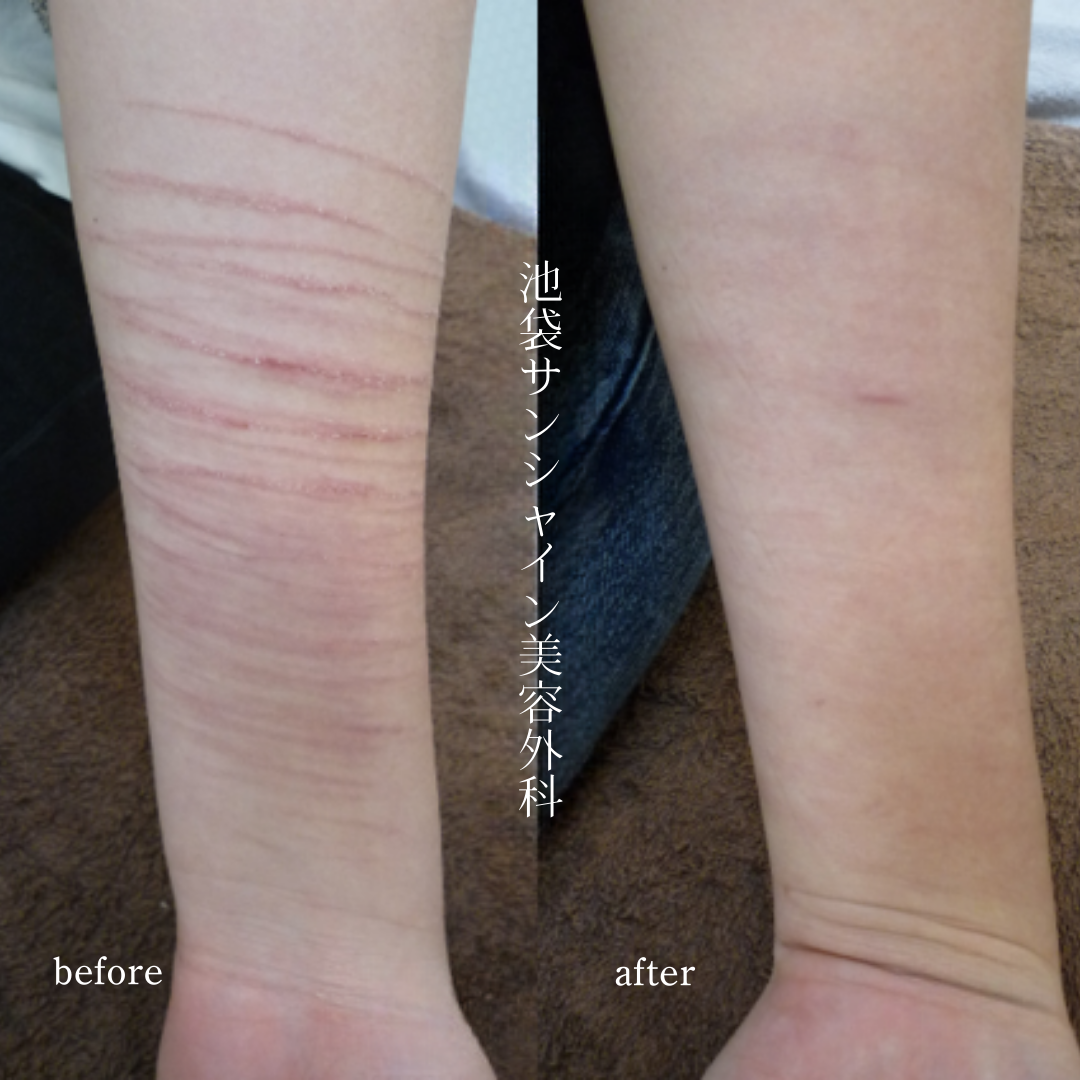 左前腕　赤い新しいリストカットの症例