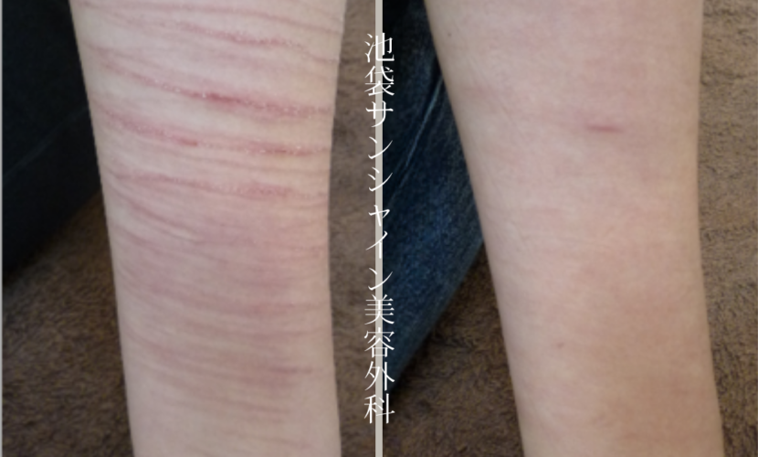 左前腕赤い新しいリストカットの症例