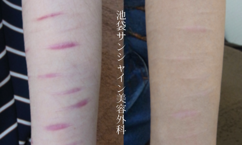 左前腕ケロイド状に盛り上がった傷