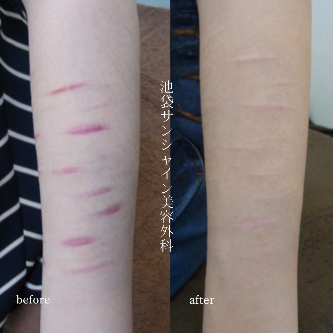 左前腕ケロイド状に盛り上がった傷