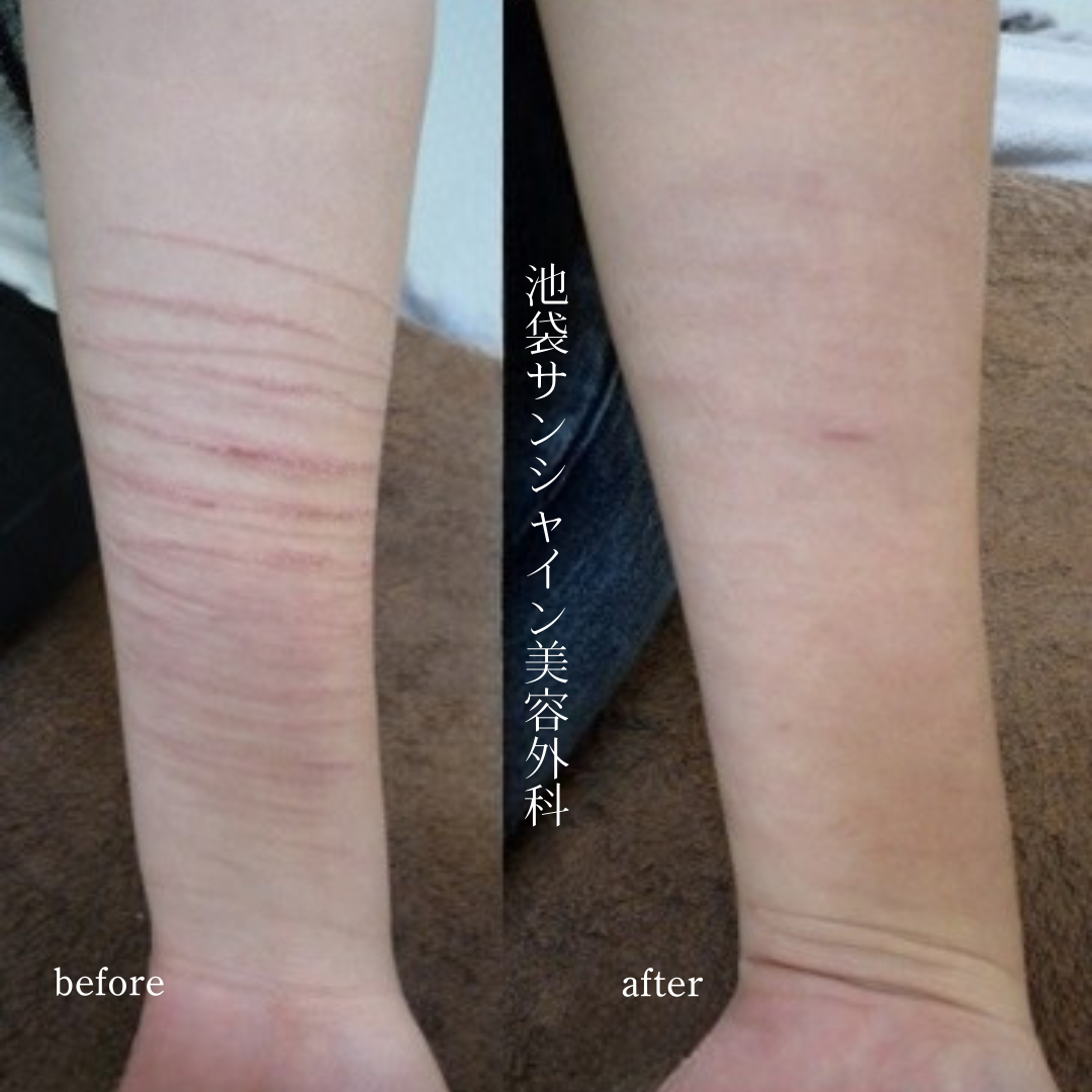 左前腕全体に広がるリストカット