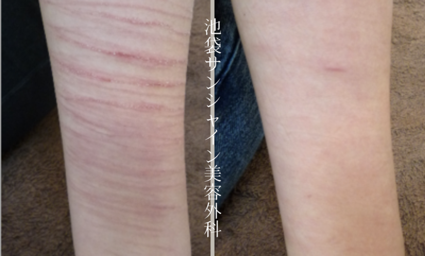 左前腕全体に広がるリストカット