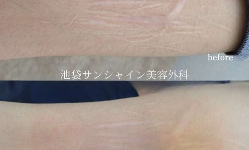 左前腕外側ひっかき傷が多数ある症例