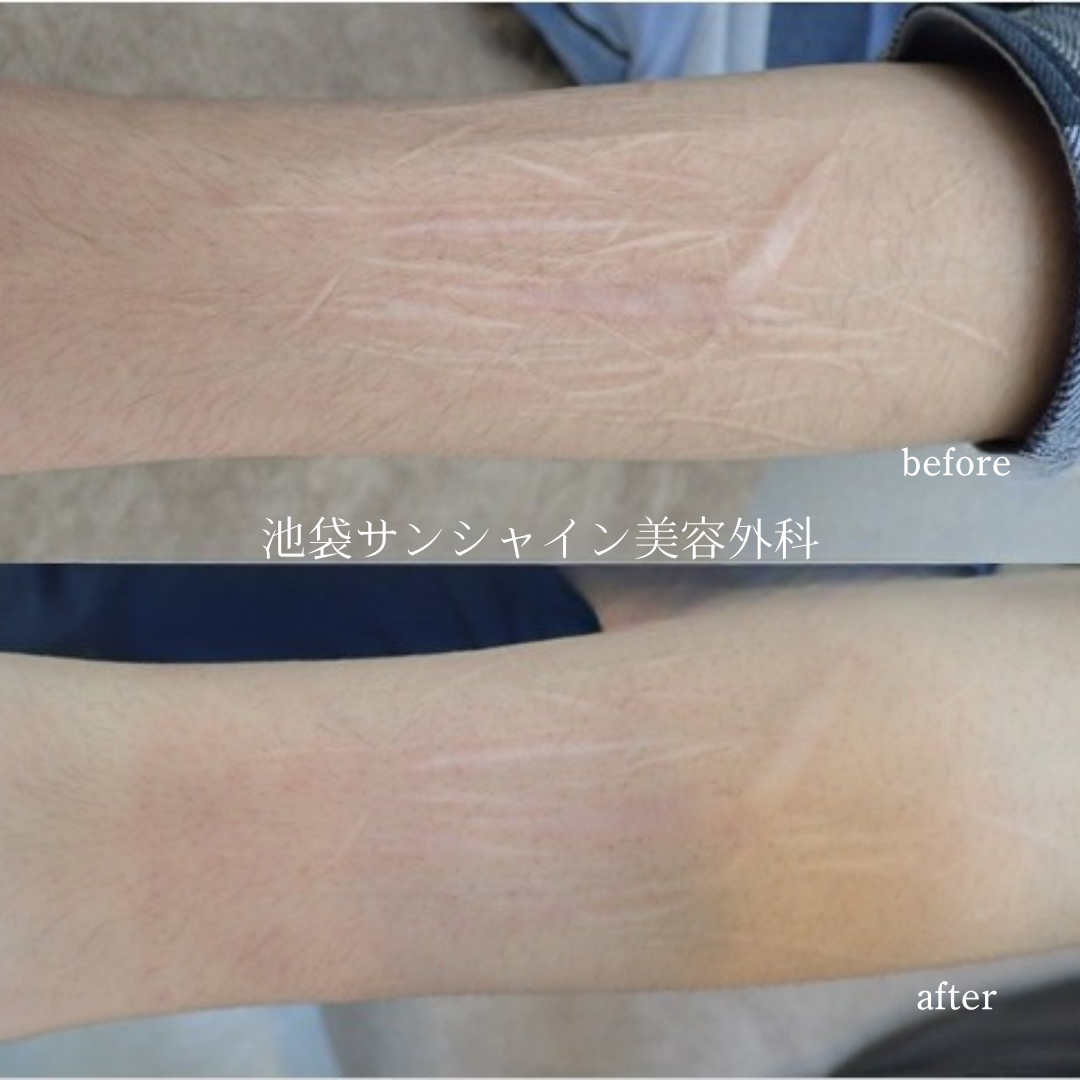 左前腕外側ひっかき傷が多数ある症例