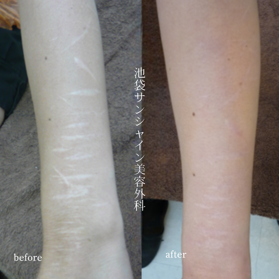 左前腕外側太く幅が広い傷が多数ある症例