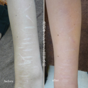 【現役医師監修】リスカ跡の白い線を消すことはできる?原因・治療法・費用まで徹底解説 6 左前腕外側太く幅が広い傷が多数ある症例