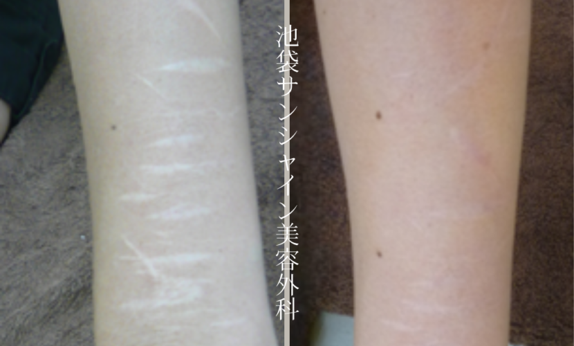 左前腕外側太く幅が広い傷が多数ある症例