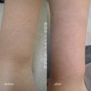 左前腕外側細い傷が多数ある症例