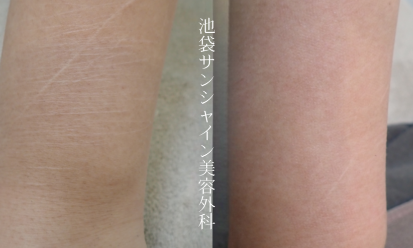 左前腕外側細い傷が多数ある症例