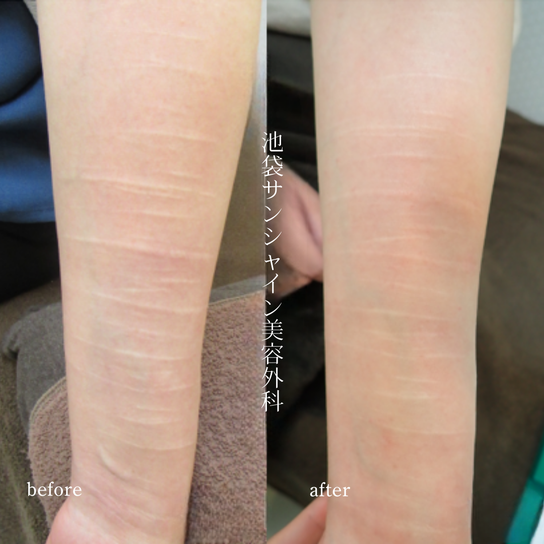 左前腕白く盛り上がった傷の症例