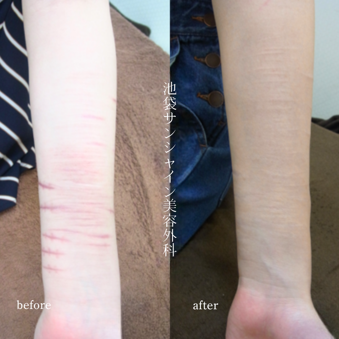 左前腕縫った傷と白い傷の混在の症例