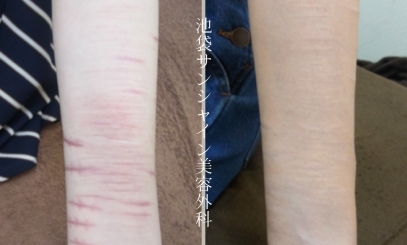 左前腕縫った傷と白い傷の混在の症例