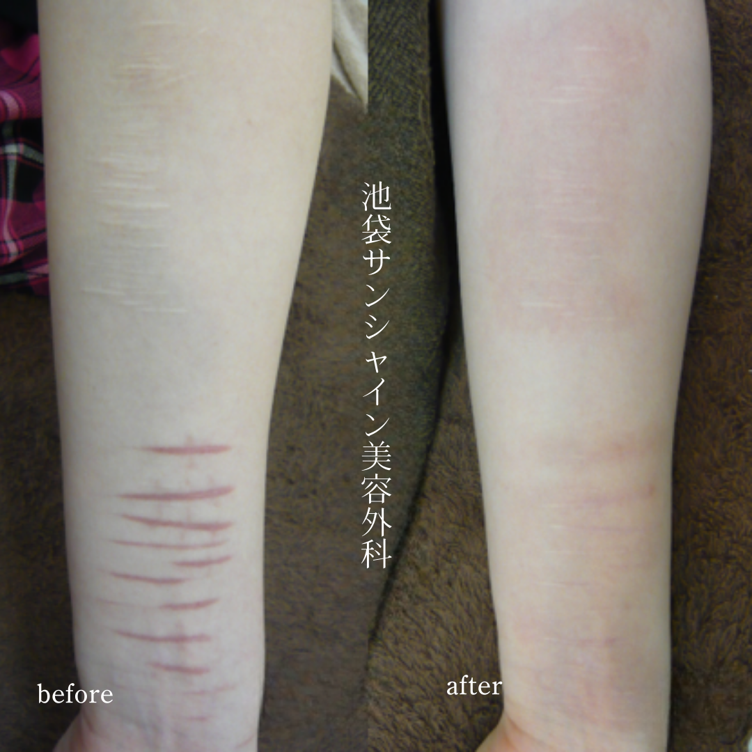 左前腕赤い傷と白い傷のある症例