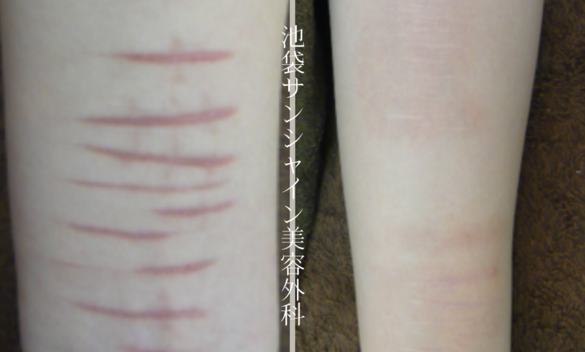 左前腕赤い傷と白い傷のある症例