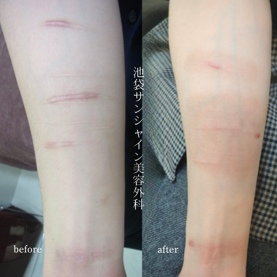 左前腕赤くケロイドになった傷の症例