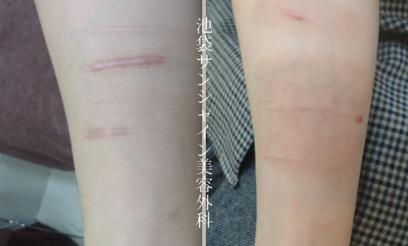 左前腕赤くケロイドになった傷の症例