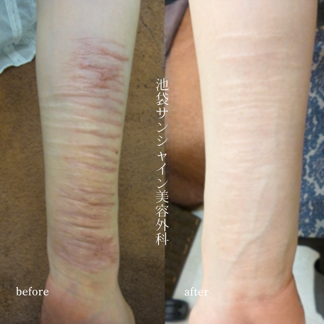 左前腕赤く太い傷跡がたくさん重なっている症例