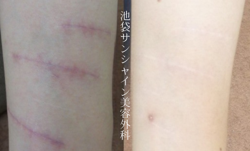 左前腕３本の赤い傷のリストカット