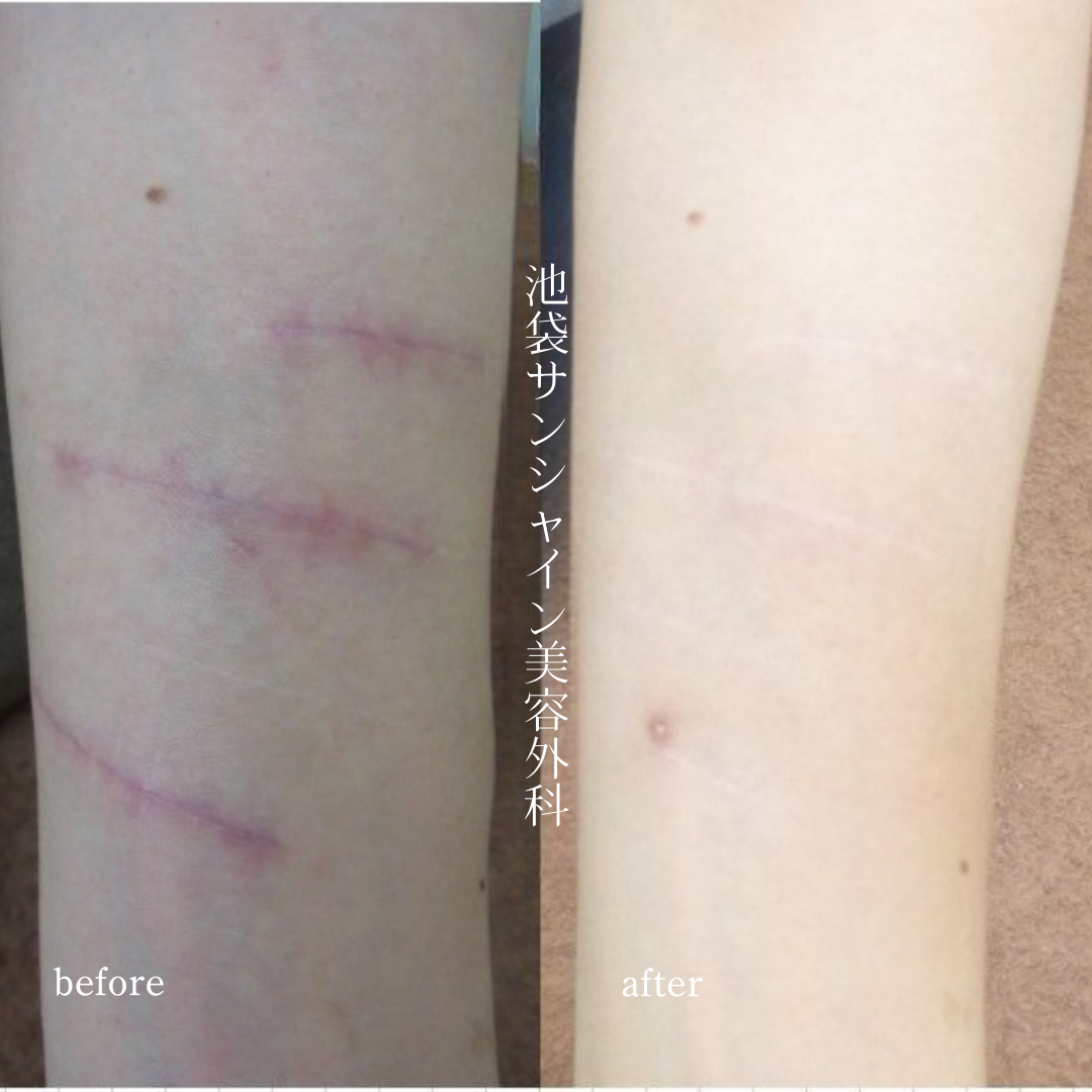左前腕３本の赤い傷のリストカット