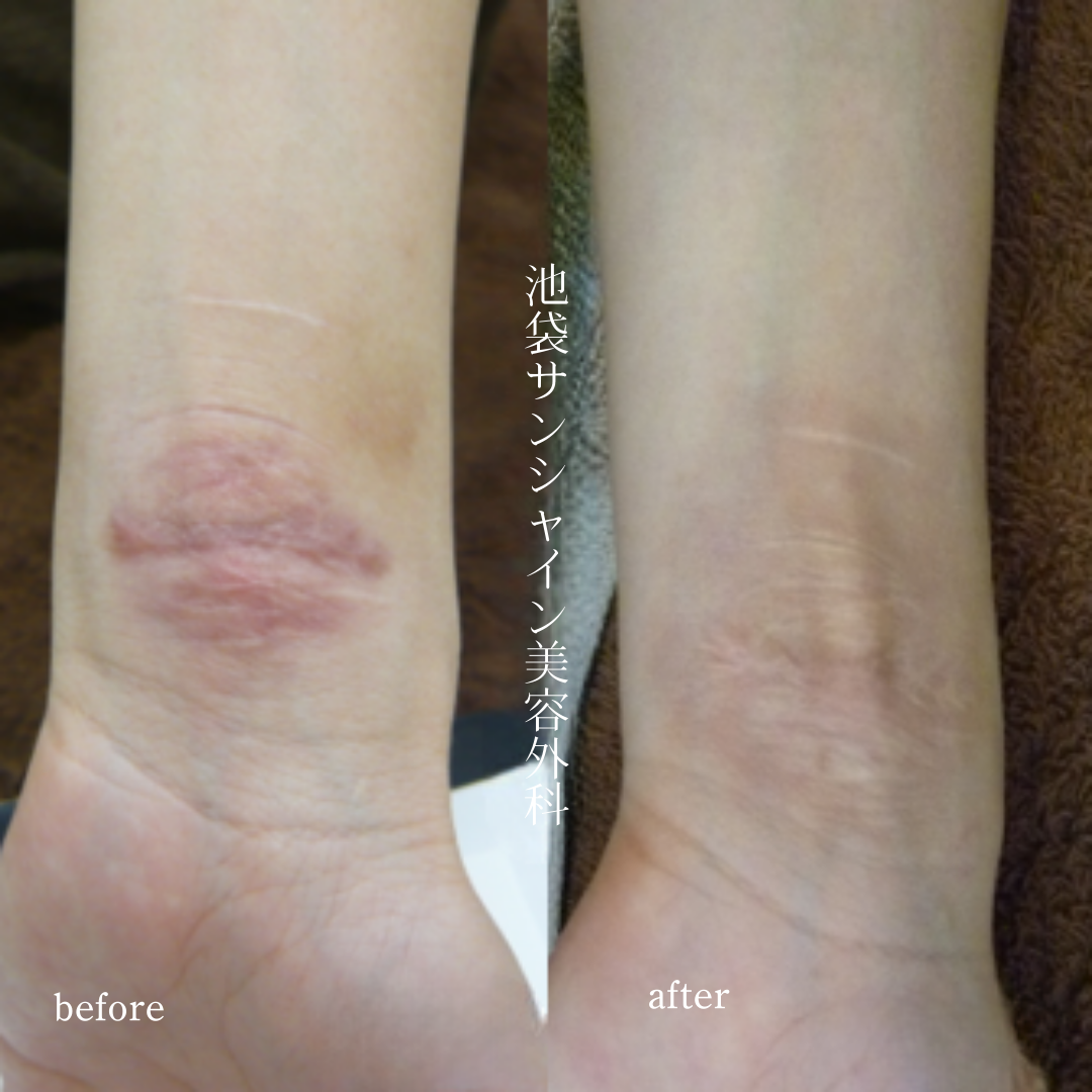 左手首同じ箇所を重ねて傷ができている症例