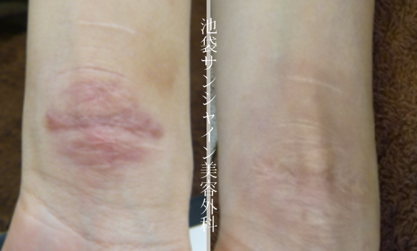 左手首同じ箇所を重ねて傷ができている症例