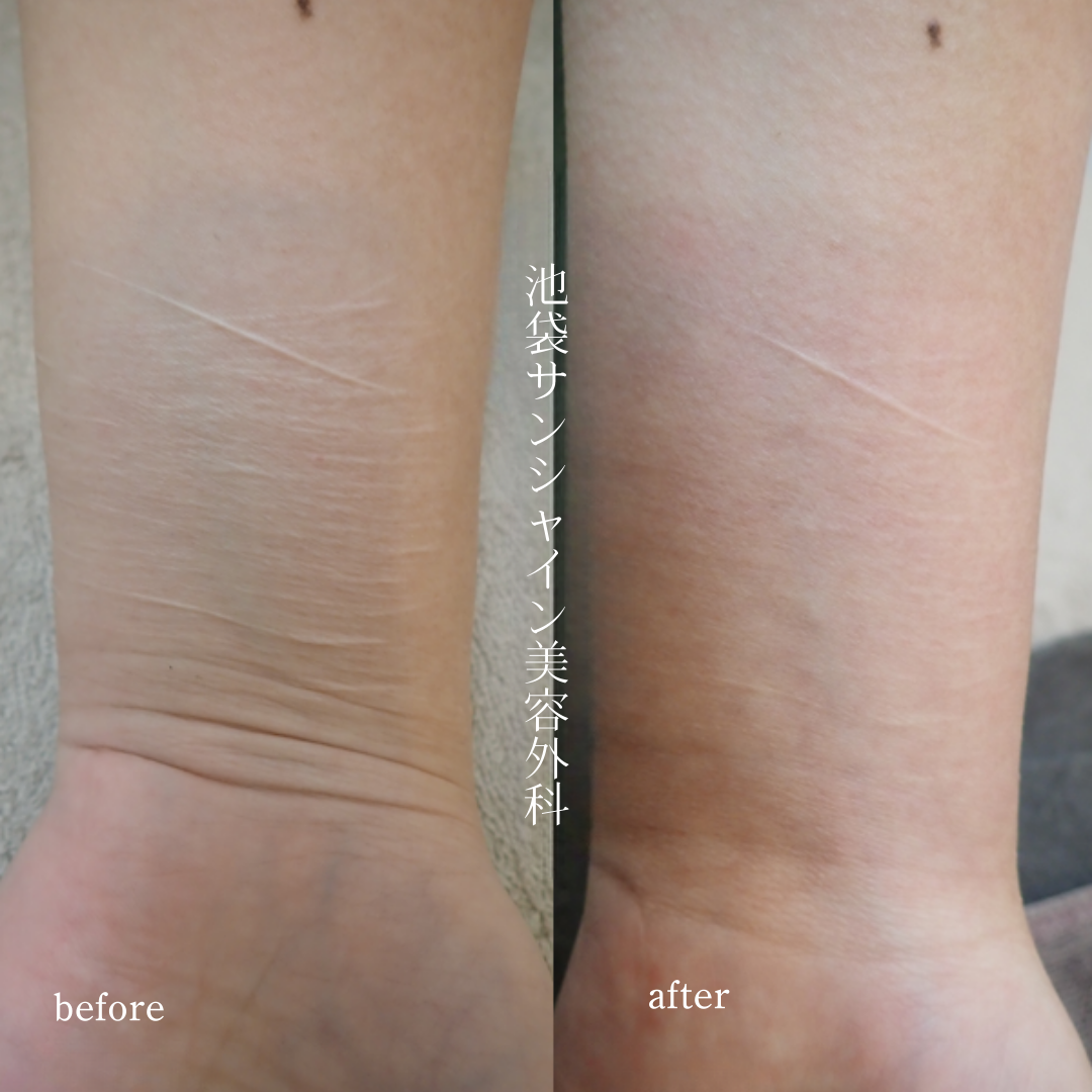 左手首白い細い傷が多数ある症例