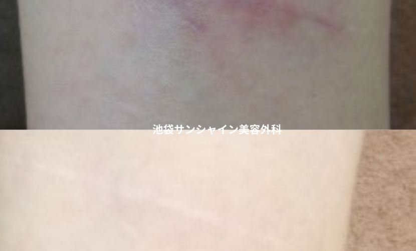 赤い傷跡の治療2