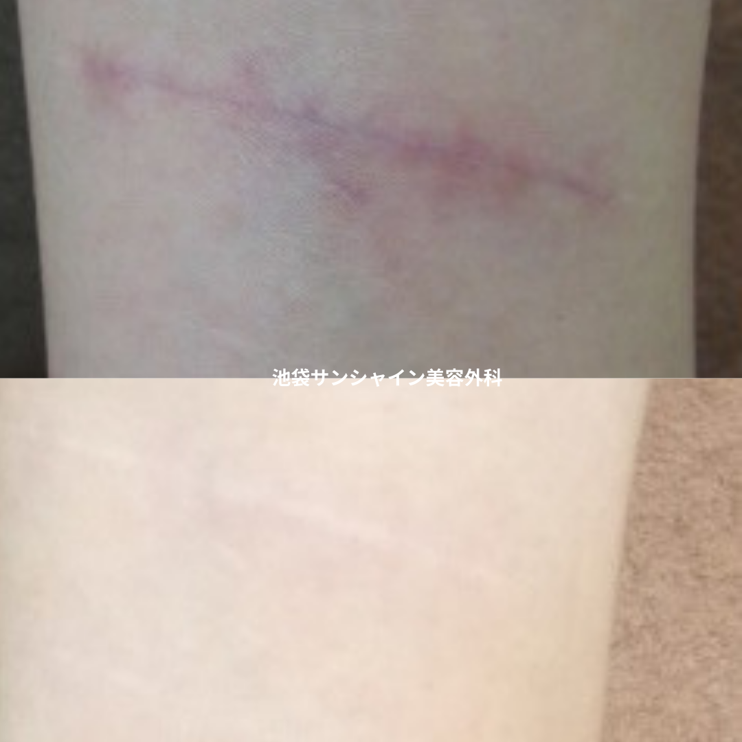 赤い傷跡の治療2