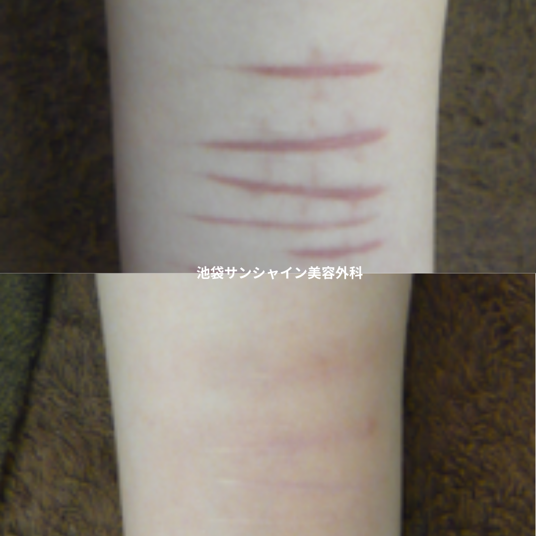 赤い傷跡の治療11