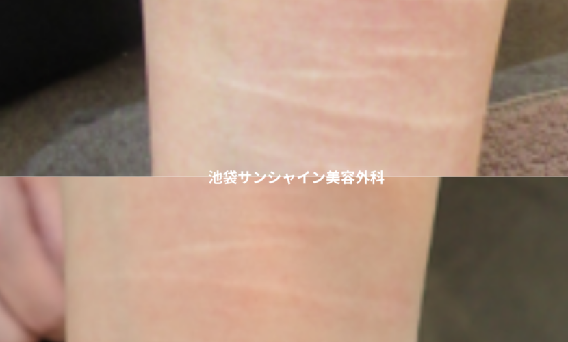 白い傷跡の治療2