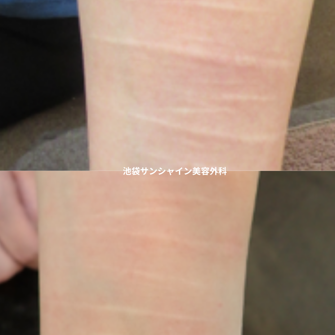 白い傷跡の治療2