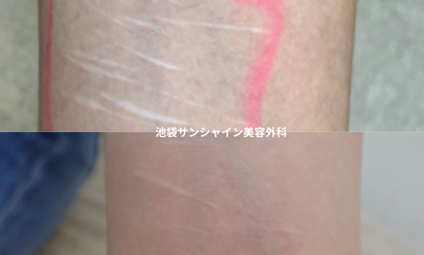 白い傷跡の治療3