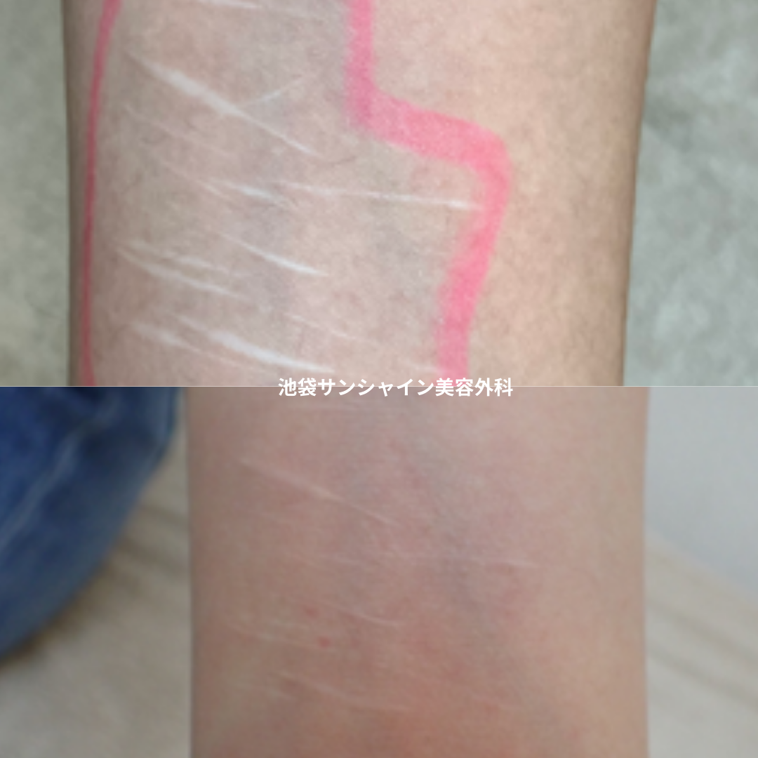白い傷跡の治療3