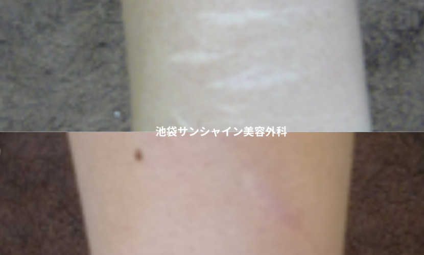 白い傷跡の治療4