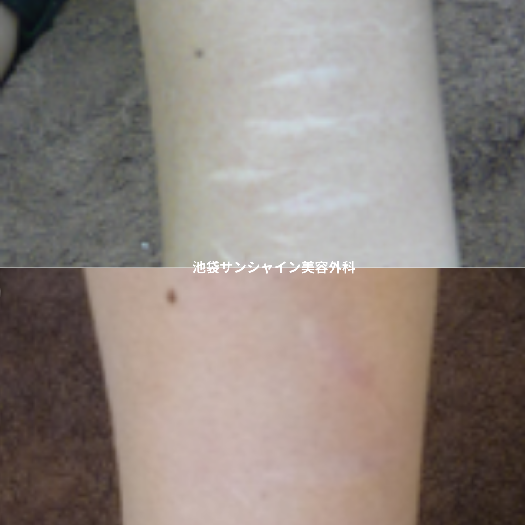 白い傷跡の治療4