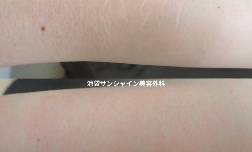 白い傷跡の治療5