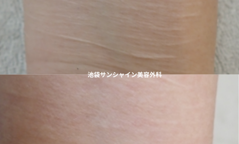 白い傷跡の治療6