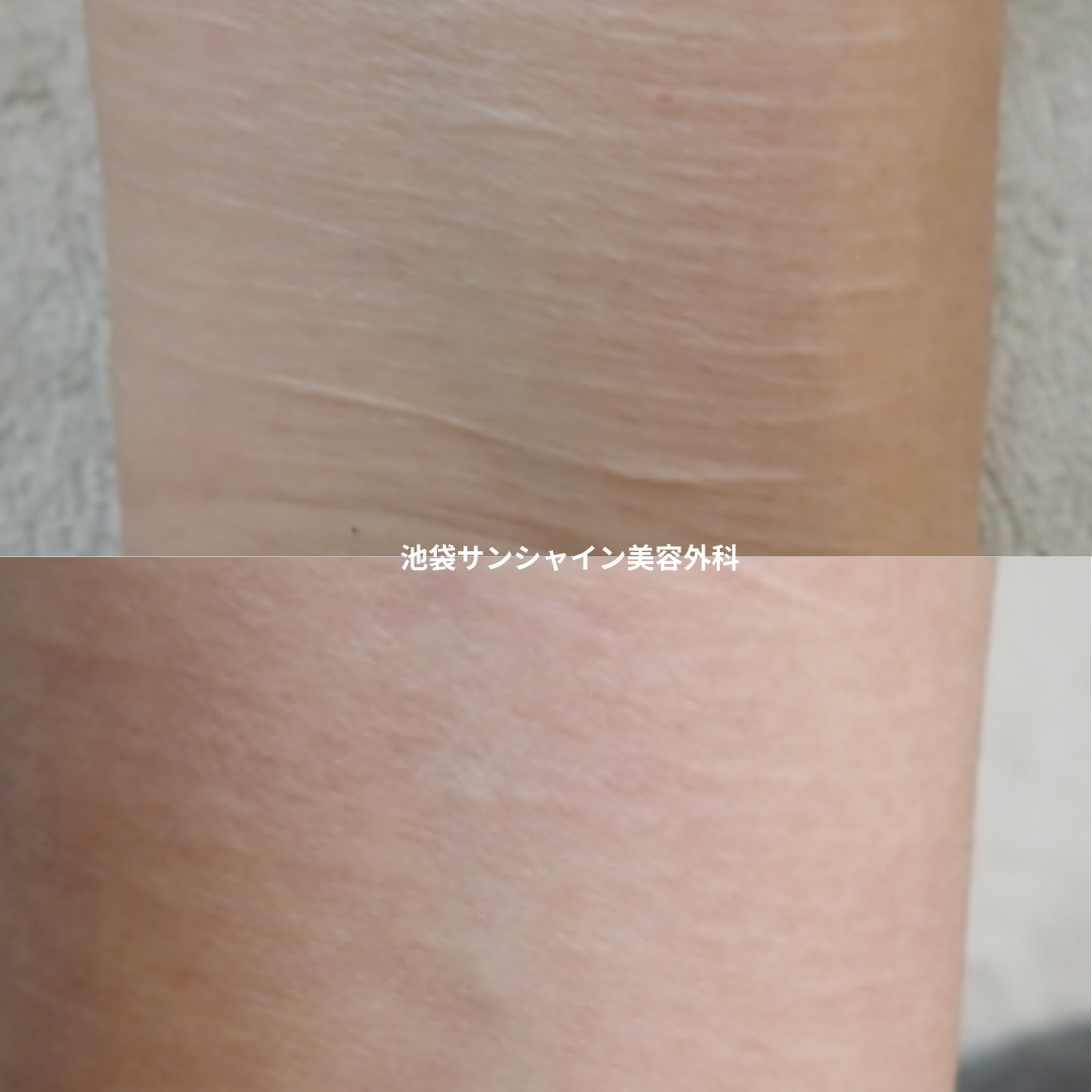 白い傷跡の治療6